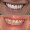 For a dream smile – your Hollywood smile at YesSmile