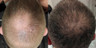 hair loss treatment Dallas TX